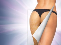 Lato bez cellulitu: jak naprawdę skutecznie pokonać pomarańczową skórkę?