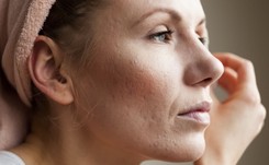 Jedna choroba, różne oblicza. Jak leczyć trądzik różowaty?