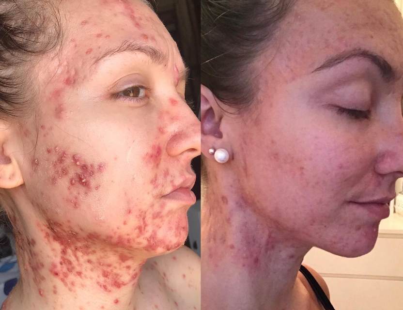 Mandy Nazé strpčovalo život akné. 