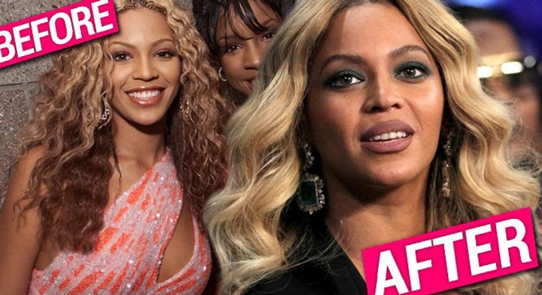 Has Beyonce done surgery on her face?