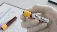 Prosztatarák: ezt az értéket nézesse meg a vérvételkor! című cikk nyitóképe