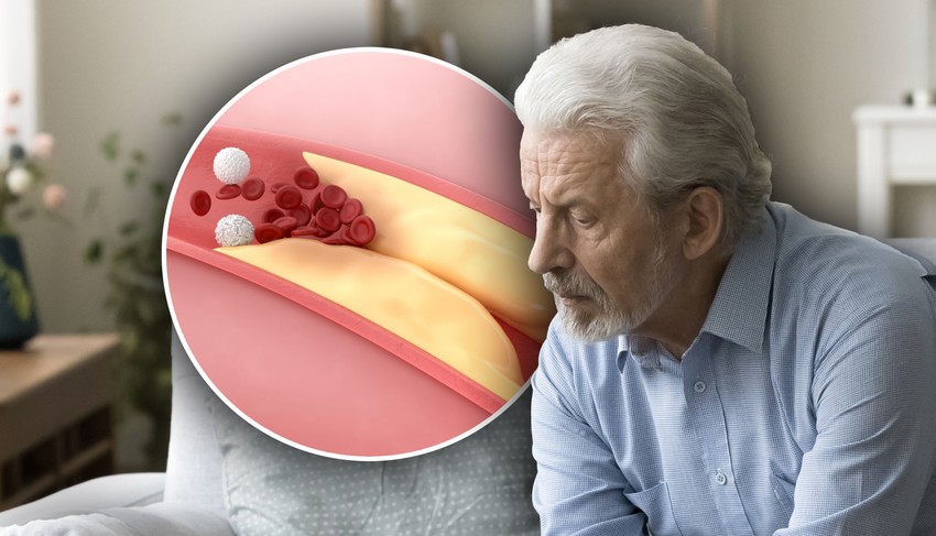 Jedan od prvih simptoma visokog holesterola može biti povećan umor 