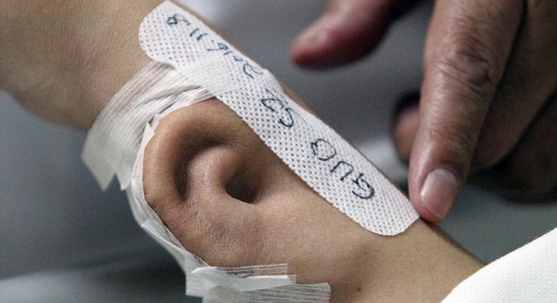 An artificial ear is seen growing on the arm of a patient whose name is Ji.