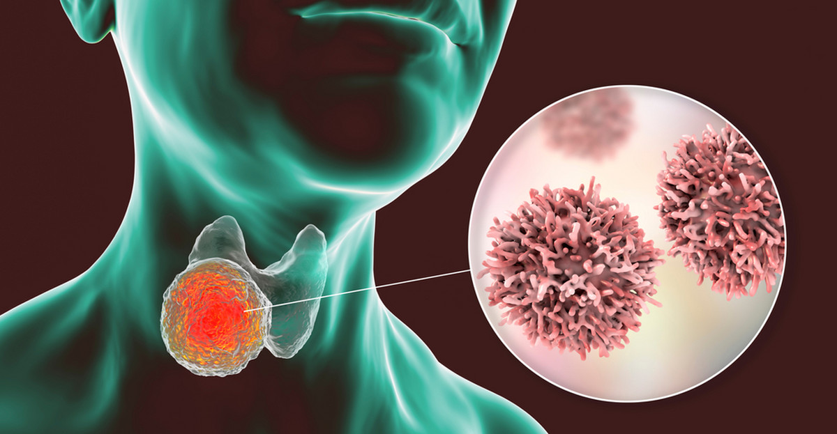 Siedem łatwych Do Przeoczenia Objawów Raka Tarczycy 3266