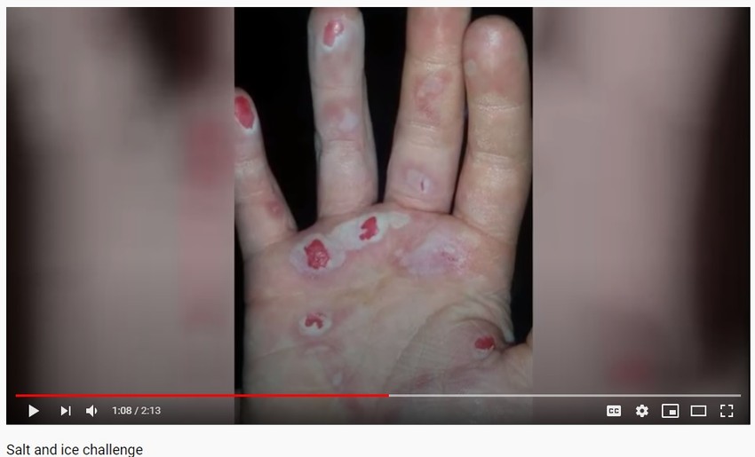 So i led izazov: zbog ovoga su mnogi imali opekotine po telu!