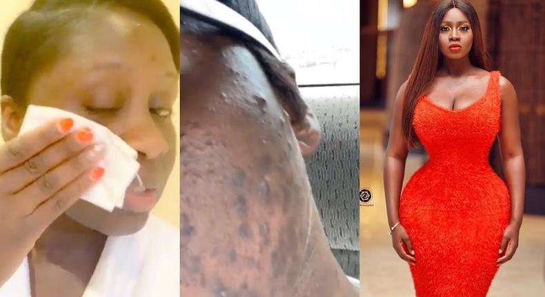 Princess Shyngle finds a cure to her acne disaster