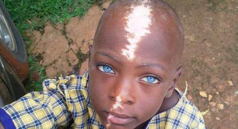 This abandoned little boy becomes internet sensation due to his unique birth mark