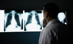 Immunoterapia. Nowa nadzieja w leczeniu agresywnego raka płuca