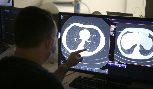 Uloga inovativnih lekova u borbi protiv raka pluća