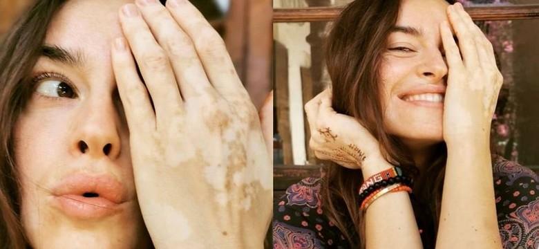 Kasia Smutniak cierpi na bielactwo: Przez ostatnie 6 lat uczyłam się akceptować siebie