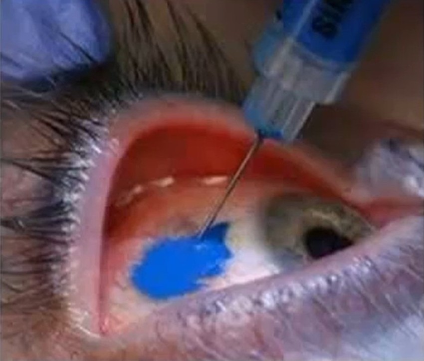 Plave oči - bukvalno