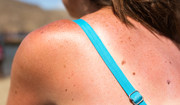  Czy stosowanie kremów z filtrem UV zmniejsza ryzyko czerniaka? 