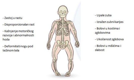 Znaci rahitisa Foto: Slika: Ref. Beck-Nielsen, S.S., Mughal, Z., Haffner, D. et al. FGF23 and its role in X-linked hypophosphatemia-related morbidity. Orphanet J Rare Dis 14, 58 (2019). https://doi.org/10.1186/s13023-019-1014-8