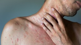 "Me enfermé cuando tenía 51 años.  Contraje el virus en la clínica.  En la fiebre, sentí como si las paredes se movieran."