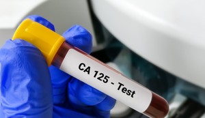 Tumor marker  CA 125 meri nivo istoimenog proteina koji može biti povišen u slučajevima raka jajnika 