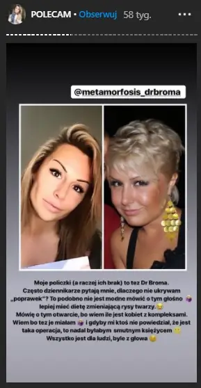 Blanka Lipińska o operacjach plastycznych / InstaStories Blanki Lipińskiej