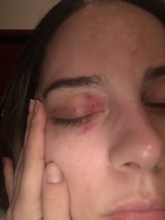 Povreda oka nakon nekoliko dana od napada