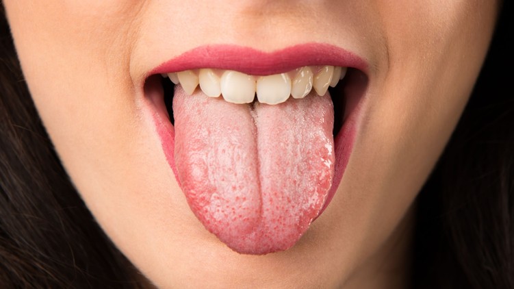 térkép nyelv gyulladás vörös