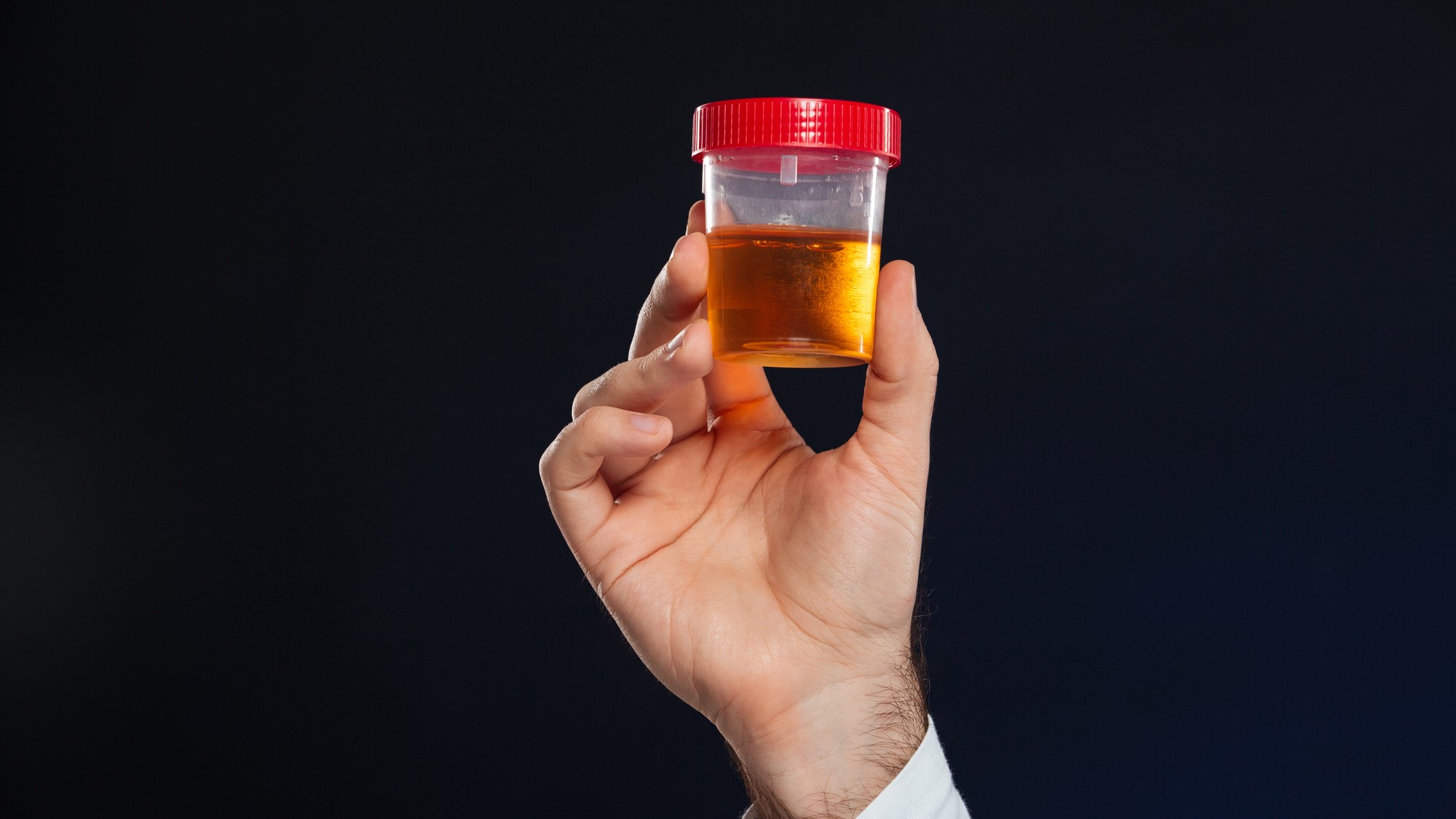 Vzorka moču môže obsahovať fragmenty DNA uvoľnené nádorom. Nový test dokázal v klinickej štúdii zachytiť viac ako deväť z desiatich prípadov rakoviny močového mechúra. (Ilustračný obrázok)