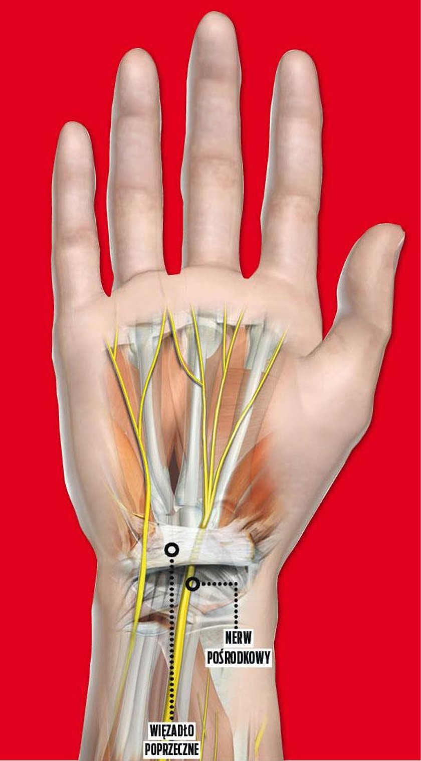 Zespół cieśni nadgarstka. Może i Ciebie dotyczy ten problem?