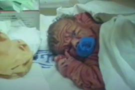 "Rodila sam prvu ovakvu bebu u istoriji - imala je KOLIČINU KOŽE jednog 5-godišnjaka": I lekari su ostali NEMI OD ŠOKA, a ovaj dečak je ODRASTAO i evo kako danas izgleda