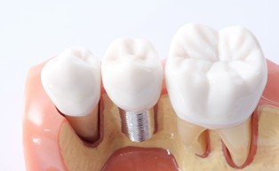 Hodowla implantów w gabinecie dentystycznym? Teraz jest to już możliwe