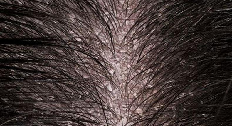 Scalp with dandruff