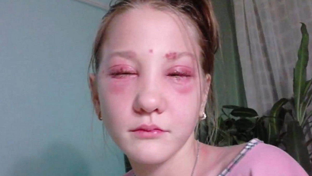 13-letnia piosenkarka Masha Kuznetsova częściowo oślepła po zafarbowaniu rzęs. Barwnik, którego użyto w salonie piękności spowodował poważne oparzenia chemiczne w okolicach oczu.