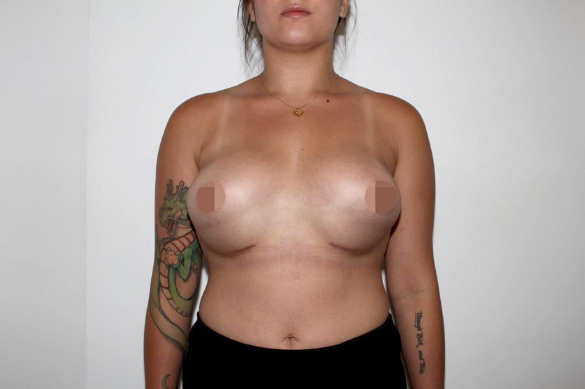 Australia: Przeszła operację powiększenia piersi. Teraz płacze