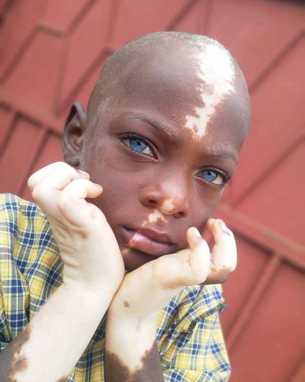 This abandoned little boy becomes internet sensation due to his unique birth mark 