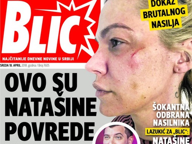 Za ove povrede Luka Lazukić kaže da su od anticelulit masaže
