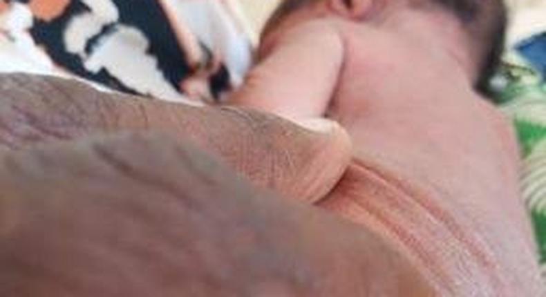 Baby born without anus in Yobe