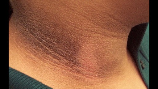 Skin hyperpigmentation 