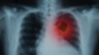 Rak płuc atakuje także niepalących. A chorzy są w najwyższej grupie ryzyka zakażenia koronawirusem