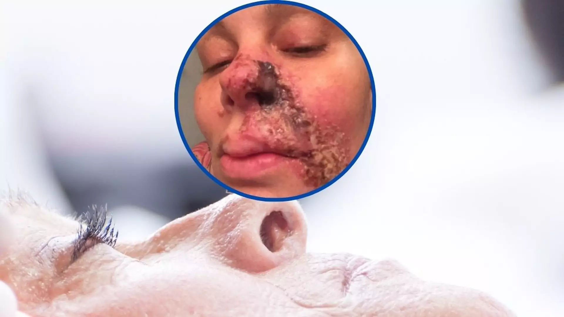 Po zabiegu upiększającym odpadła jej połowa nosa. "Moja twarz się rozpada"