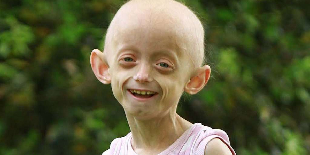 Dziewczykna chora na progerię