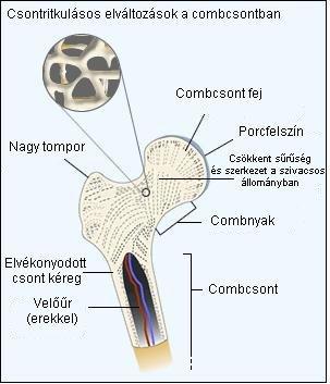csípő csontritkulás következményei