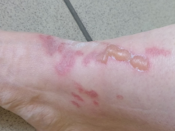 Oparzenie skóry spowodowane kontaktem z dyptamem jesienolistnym