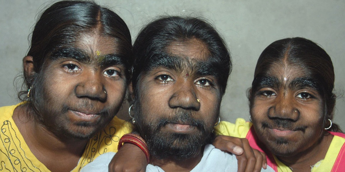 Hypertrichosis