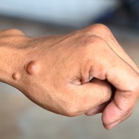 Majomhimlőnek nézte a lány bőrdaganatait a vonaton, ezt tette vele