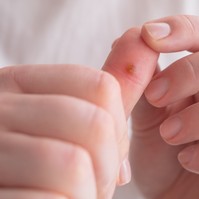 Szemölcs: tünetek, vizsgálatok és kezelési lehetőségek