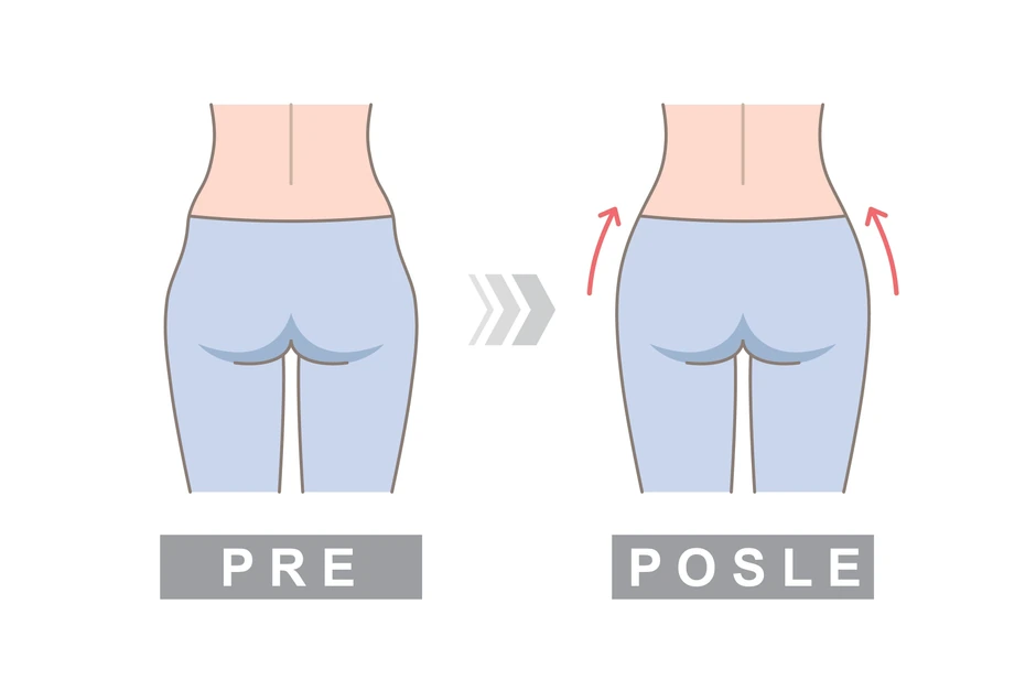 Udubljenja na kukovima ne mogu trajno da se eliminišu, osim ako se ne podvrgnete operaciji