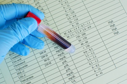 Mit jelent az LDL-koleszterin érték a laborleleten?