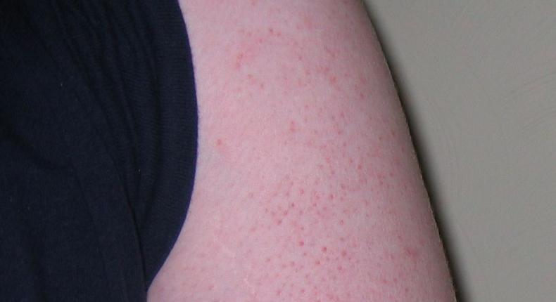 Karatosis pilaris, a sign of allergies or asthma.