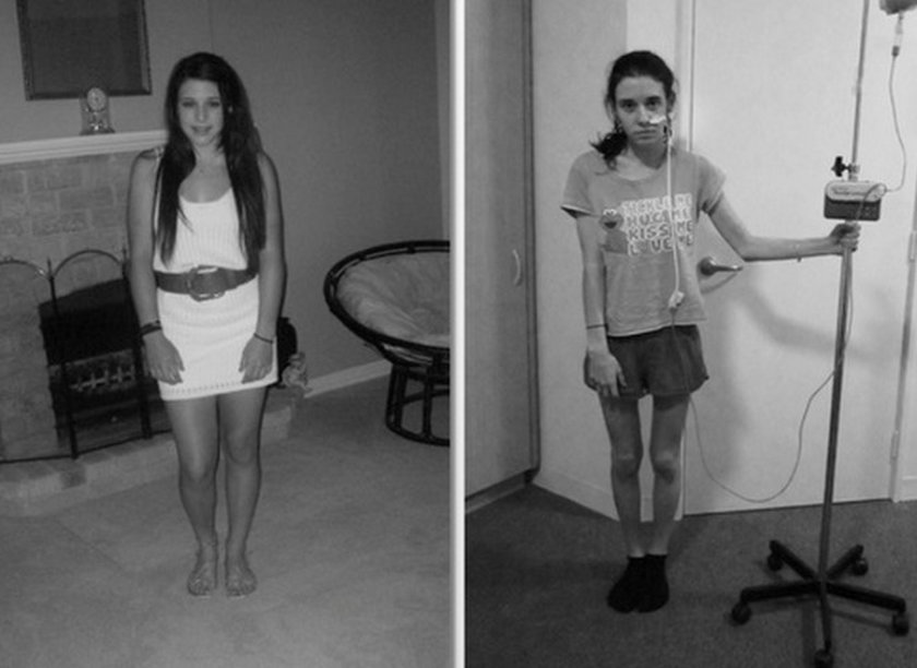 Oto, jak można wygrać z anoreksją