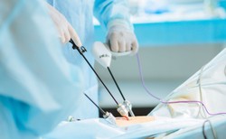 Operacje laparoskopowe – na czym polega małoinwazyjna chirurgia?