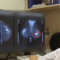Nem fáj, 3 perc: hogyan zajlik a mammográfiás vizsgálat?