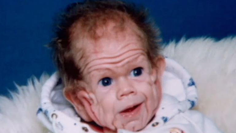 Tomm mal obrovské množstvo prebytočnej kože.