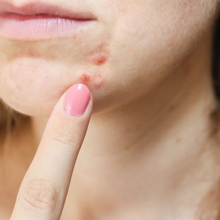 Hormonzavar is okozhatja, ha így néz ki az arcbőre