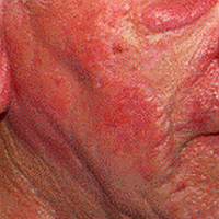 rosacea-face-d000011FC00eee0fc3449
